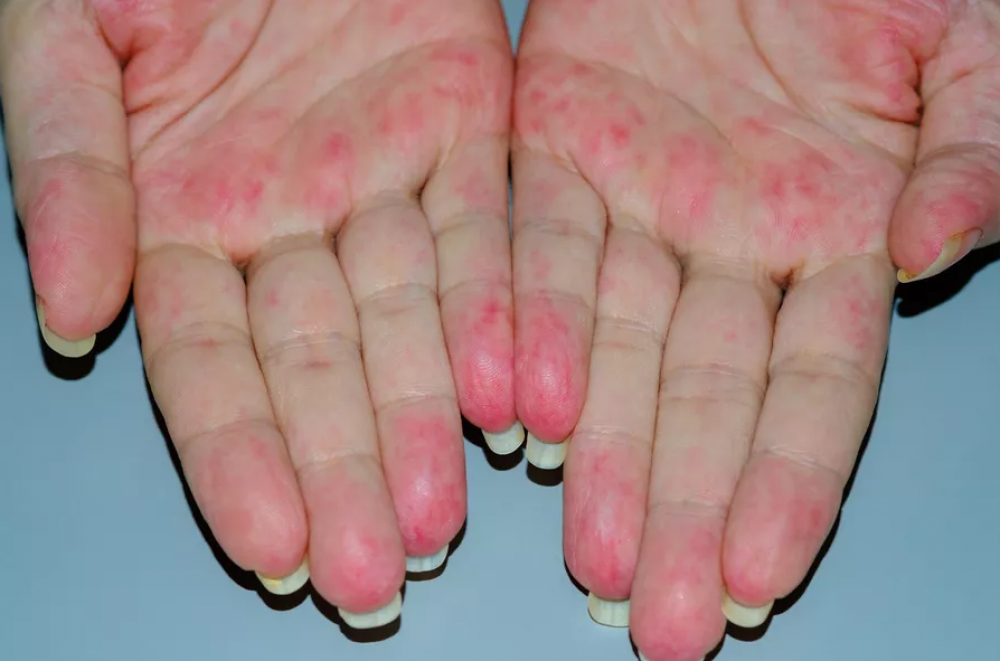 Semne pe piele de la ficat – cum se manifestă bolile hepatice la nivel dermatologic